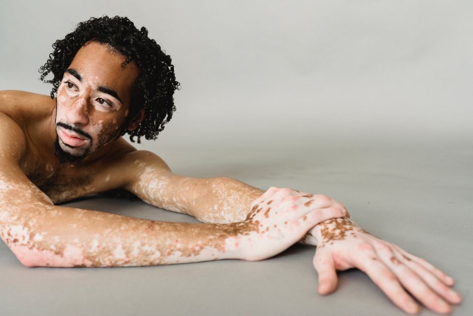 Unemotional African American male with naked torso living with psoriasis lying on floor against gray wall in studio and looking away thoughtfully