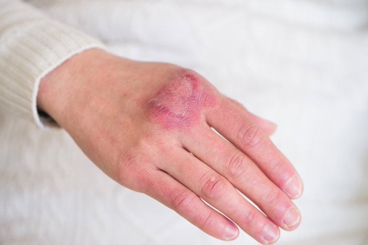 Perniose: inflamação da pele causada pelo frio e umidade