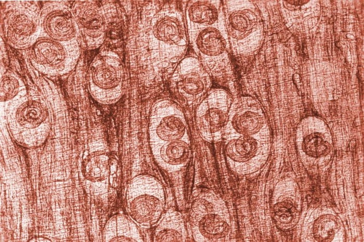 Triquinose: infecção parasitária por carne contaminada