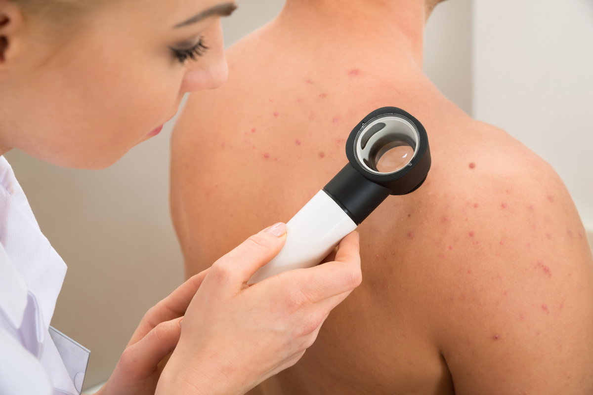 Acne fúngica: causas, sintomas e opções de tratamento